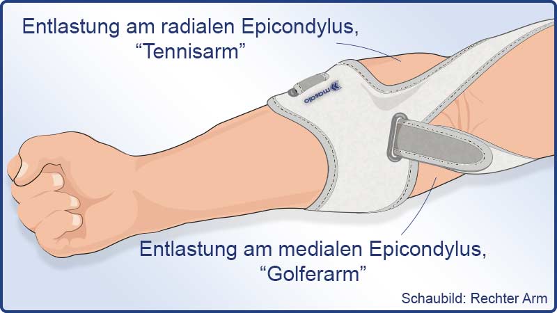 Masalo Manschette MED hilft bei Tennisarm und Golferarm