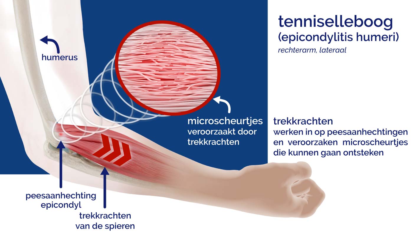 Schema van de oorzaak van epicondylitis, tenniselleboog, Masalo KG golfelleboog