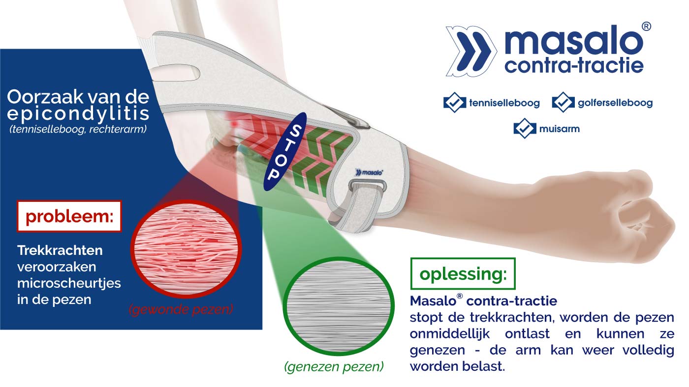 Schema van het principe van de tegenwerkende werking van de Masalo manchet tegen tenniselleboog, golferselleboog, muizenelleboog