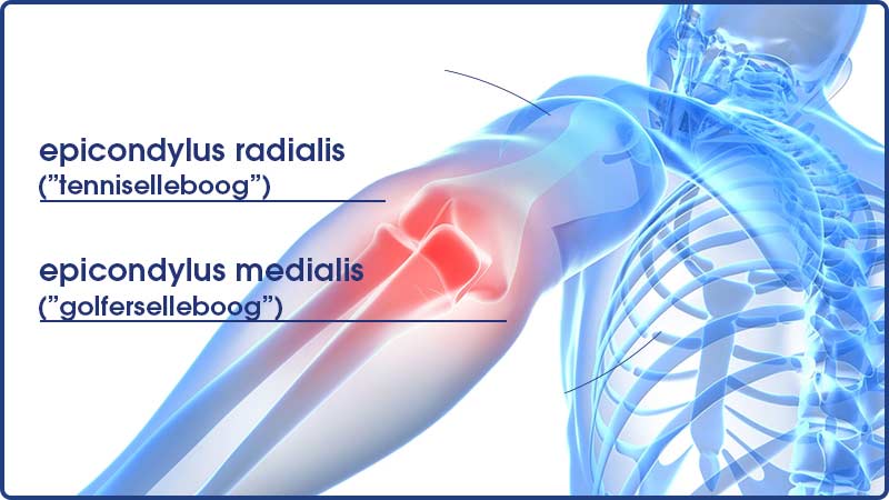 Diagram van de epicondylus radialis en epicondylus medialis