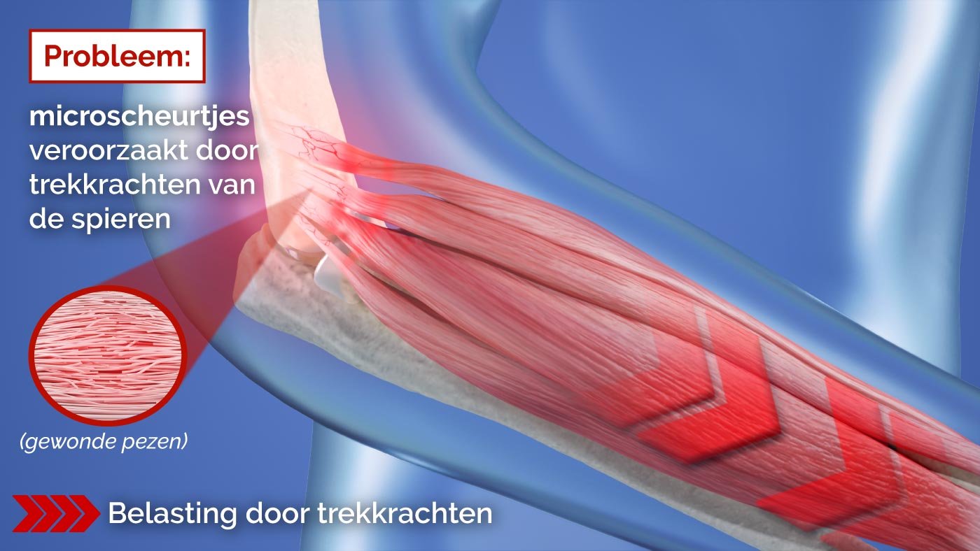 Oorzaak van de epicondylitis